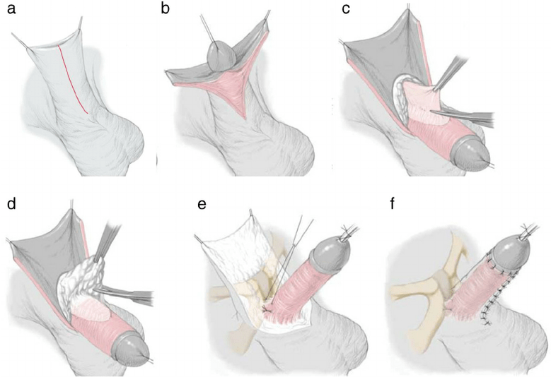 Ligamentotomie zur Penisvergrößerung